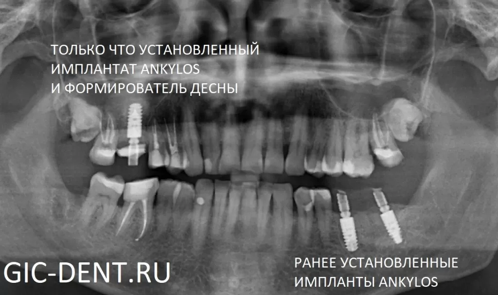 На снимке - результат синус-лифтинга и имплантации зуба в немецком имплантологическом центре